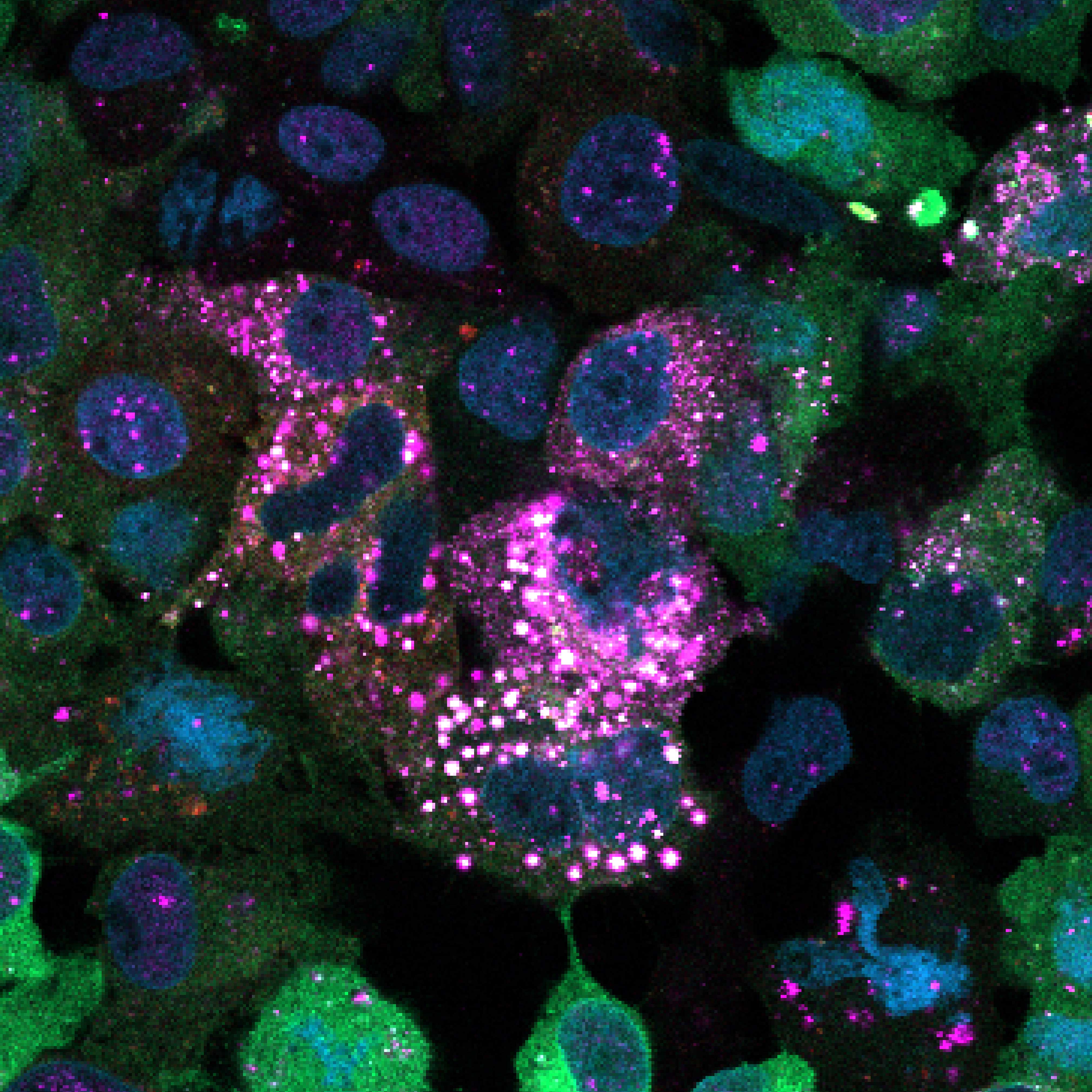 This image shows human liver cells treated with a drug that induces glycogen ubiquitination. The bright white speckles appear where glycogen and ubiquitin overlap, indicating that glycogen has been tagged with ubiquitin inside the cells.