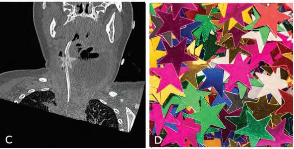 Coronal computed tomography (CT) neck scan. CT reconstruction with the ingested star clearly outlined beside the abscess with overlying nasogastric tube (C). Confetti star of the same make that was found during surgery  (D). Paul Heyworth and Ryan Shulman
