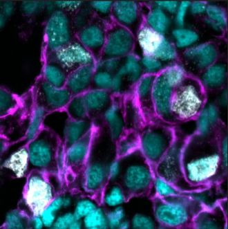 A section of liver tumour in a zebrafish