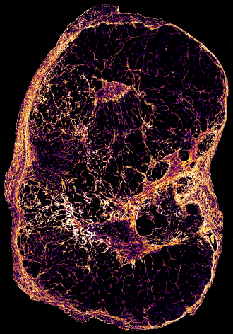 A microscopic view of a slow-growing breast cancer tumour