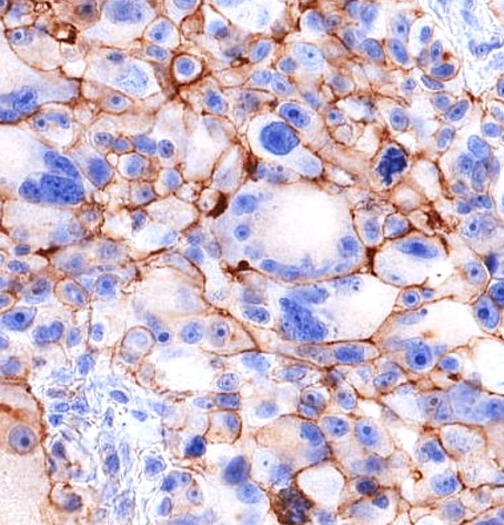 Melanoma tumour cells expressing CD155 - supplied QIMR Berghofer