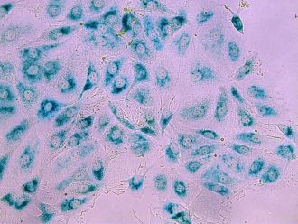 Breast cancer cells in their 'sleeping' state (senescence) after treatment. When the JNK pathway is disrupted, cancer cells are less likely to enter this state and instead continue dividing, leading to therapy resistance
