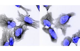 Neuroblastoma cells under the microscope