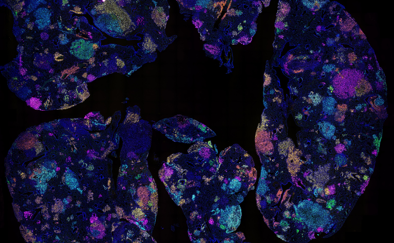 This image shows tumours growing in a mouse lung, with the colours indicating different gene deletions. The team used mouse models in the study to show the protein signature reflects an altered inflammatory lung environment before cancer takes hold. Credit: WEHI