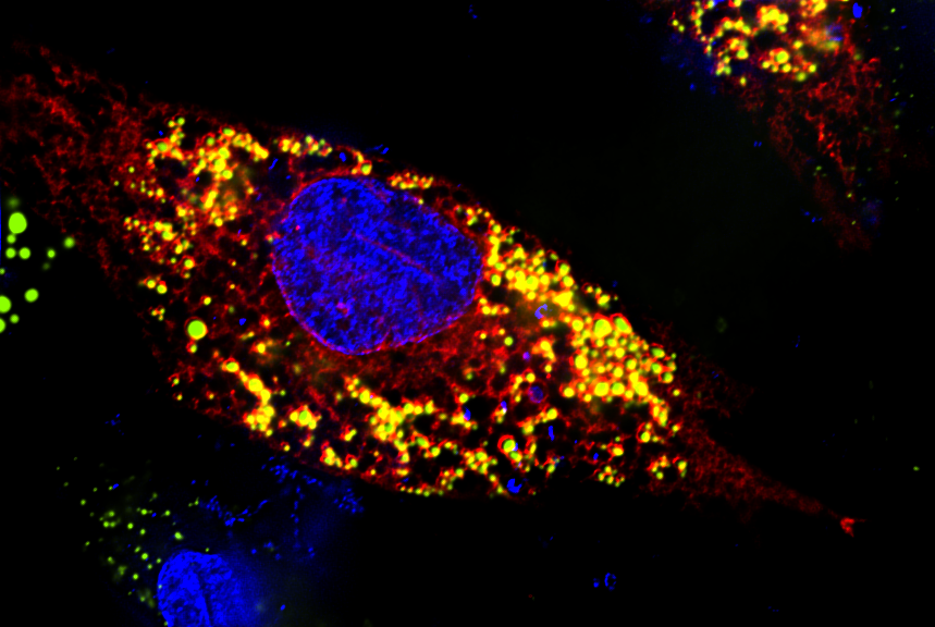 Microscopy of a brain cell infected with Zika virus. The yellow areas show where BODIPY lipid droplets and Viperin antiviral proteins have come together to fight the infection. 