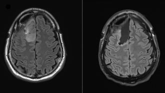 Brain scans - BrainPOP study