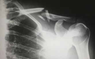 Korean and US researchers have modified a glue gun to print out bone grafts, which they say could be 3D printed directly onto fractures and defects during surgery. The tool has so far been tested in rabbits, where the team was able to quickly create complex bone implants without the need for prefabricated parts being made in advance. Additionally, the team made these grafts with high structural flexibility, as well as the ability to release anti-inflammatory antibiotics and aid natural bone regrowth at the grafting site. Importantly, our current methods of fixing bones use either metal, donor bone or 3D printed materials to repair the break - all of which take time to build or prepare in the case of irregular bone breaks. In this new study, the team were able to print in situ, taking a feature of natural bone that is known to promote healing and a biocompatible plastic and mixing them into a 'glue' that will bind and conform to the jagged grooves of a fractured bone.