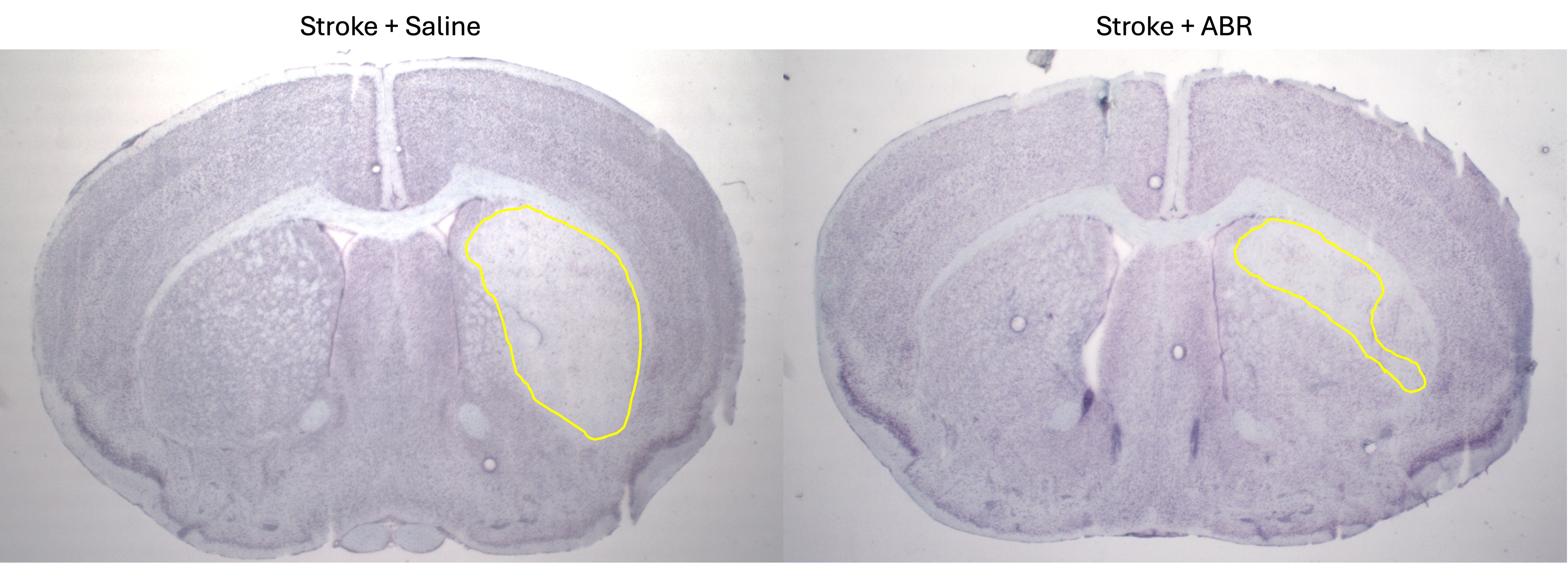 Images of brain inflammation following stroke show a 30 per cent reduction following medical intervention. Image supplied by La Trobe University