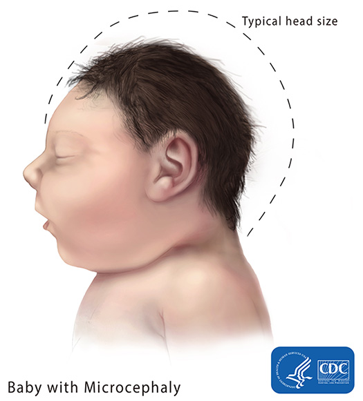 microcephaly please credit Centers for Disease Control and Prevention, National Center on Birth Defects and Developmental Disabilities