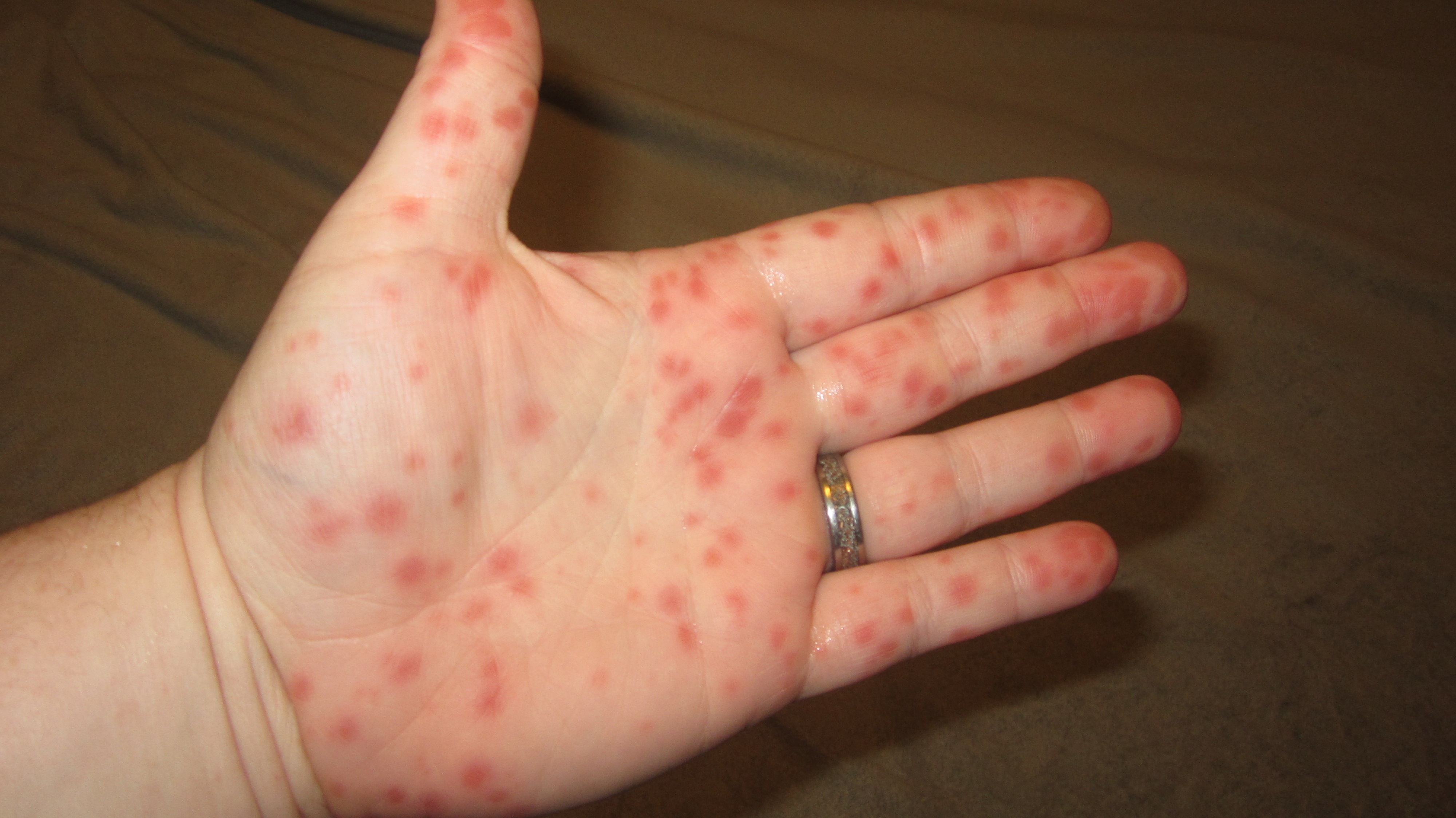 Hand, Foot and Mouth disease, Credit: Kessalia19, CC BY-SA 4.0 <https://creativecommons.org/licenses/by-sa/4.0>, via Wikimedia Commons