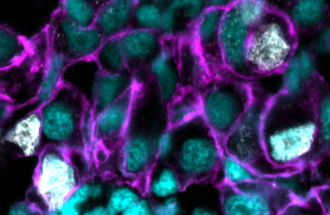 WEHI researchers have discovered a promising new strategy to suppress the growth of aggressive and hard-to-treat cancers by targeting a specialised molecular process known as ‘minor splicing’. Blocking minor splicing can markedly slow tumour growth in liver, lung and stomach cancers, while leaving healthy cells largely unharmed, the team found. The research in animal models and human cells demonstrates the potential of this strategy to target cancers driven by mutations in common cancer-causing genes.