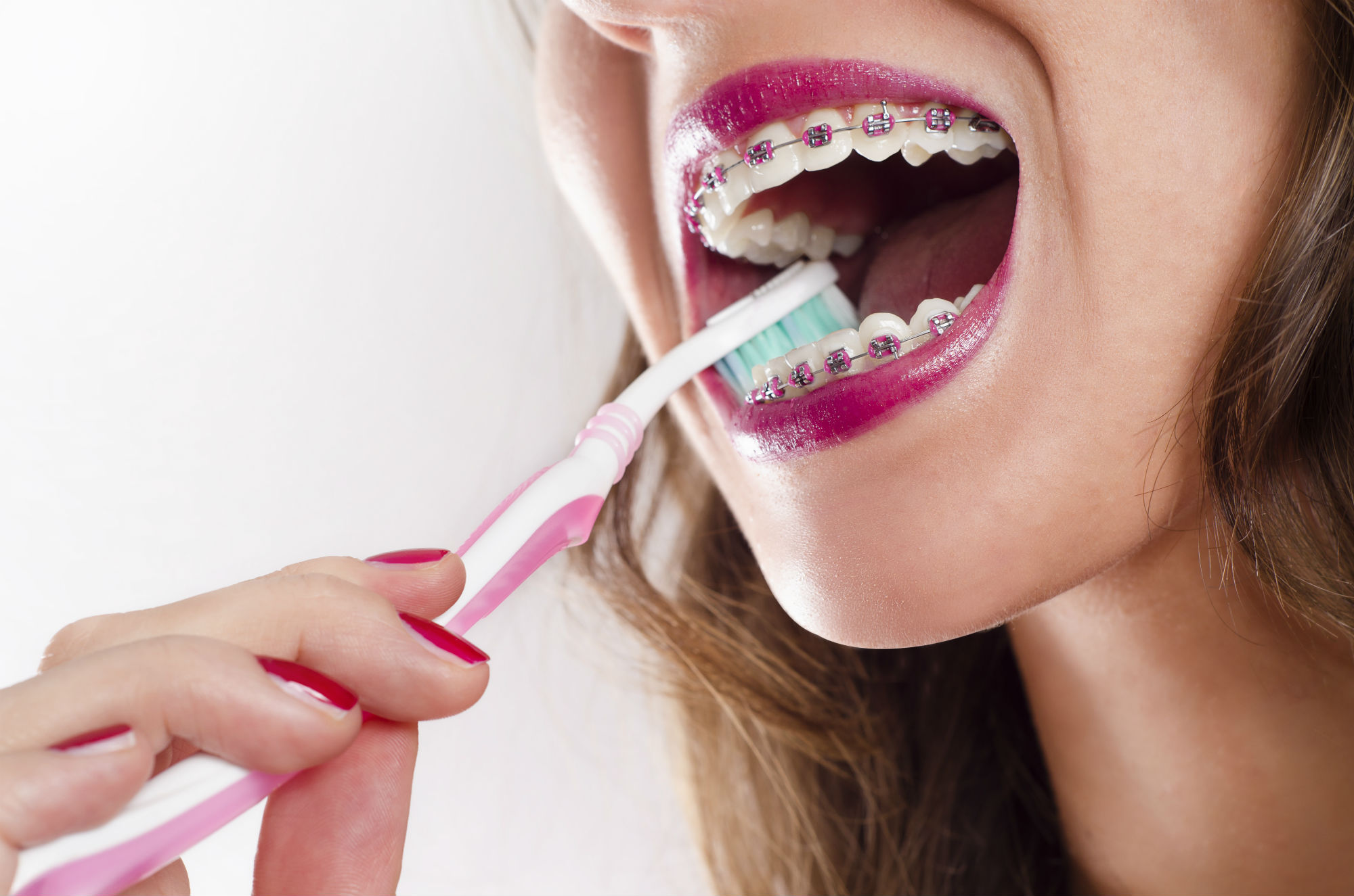 IStock Image / Orthodontics no guarantee of long-term oral health