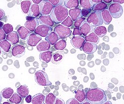 Acute Myeloid Leukaemia image from Wikipedia