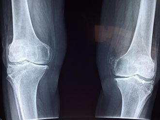 A pioneering liquid metal combination is shaping up as a potential secret weapon in the global fight against antimicrobial resistance, and promises to outlast existing implant materials. While also able to combat infections, new research at the Flinders University Biomedical Nanoengineering Laboratory also confirms the special metallic material is far more biocompatible with bones – giving patients potential for quicker healing and device longevity after major orthopaedic surgery.