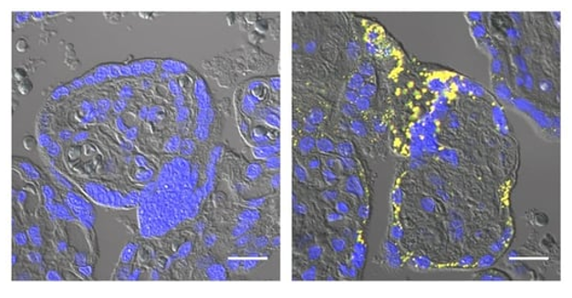 Amyloid-β aggregates (yellow) are present in preeclamptic (right) but not healthy (left) placentas. Credit: © 2026 Nishioka et al. Originally published in Life Science Alliance. Story by Dr Joe Milton, Australian Science Media Centre