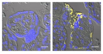 Amyloid-β - the protein that forms 'clumps' in the brains of Alzheimer's patients - may disrupt the formation of the placenta, contributing to the development of preeclampsia (pregnancy-related high blood pressure), according to Japanese and French scientists. The cause of preeclampsia remains unclear, but previous research has linked it to reduced oxygen levels and problems in placenta formation. The researchers found low oxygen levels increase the production of amyloid-β in placental cells grown in the lab, which appears to inhibit a critical step in placenta formation known as syncytialisation - when placental cells fuse to form an outer layer that protects the developing fetus. In patients, this would likely inhibit the outer layer formation and contribute to the development of preeclampsia, although further work is required to confirm this, the authors conclude.