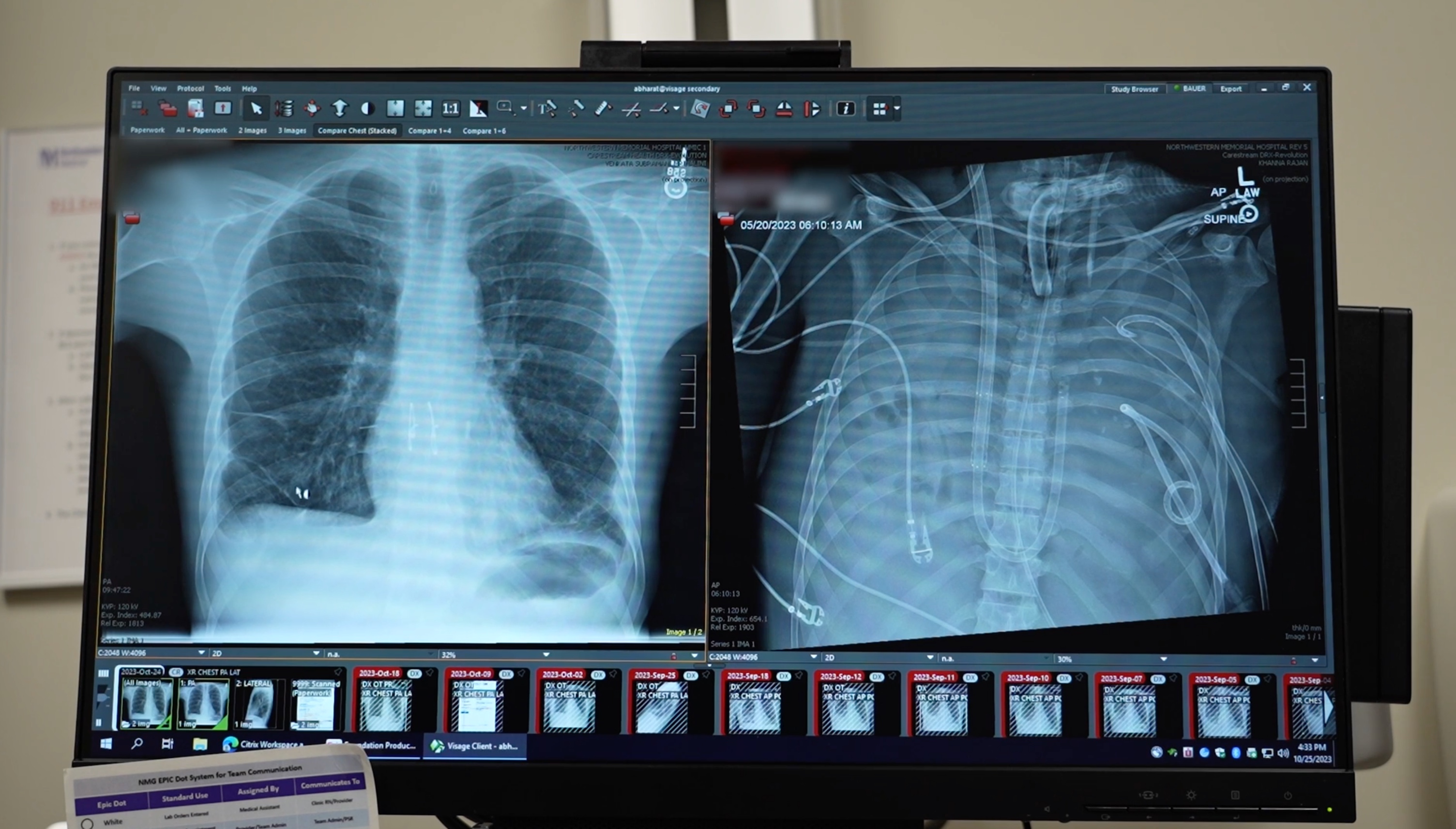 The patients’ new lungs (left) and old lungs (right).  Credit Northwestern Medicine (1), Story by Ben Kaldi - Australian Science Media Centre