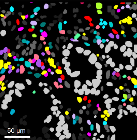 Spatial proteomic image of a lung tumour depicting the immune niche (blue, pink, purple cells) in which CD14+CD4+ T cells reside within the tumour. Tumour cells are coloured in grey. Credit: WEHI