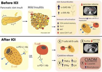 Predicting checkpoint inhibitor–associated autoimmune diabetes in humans