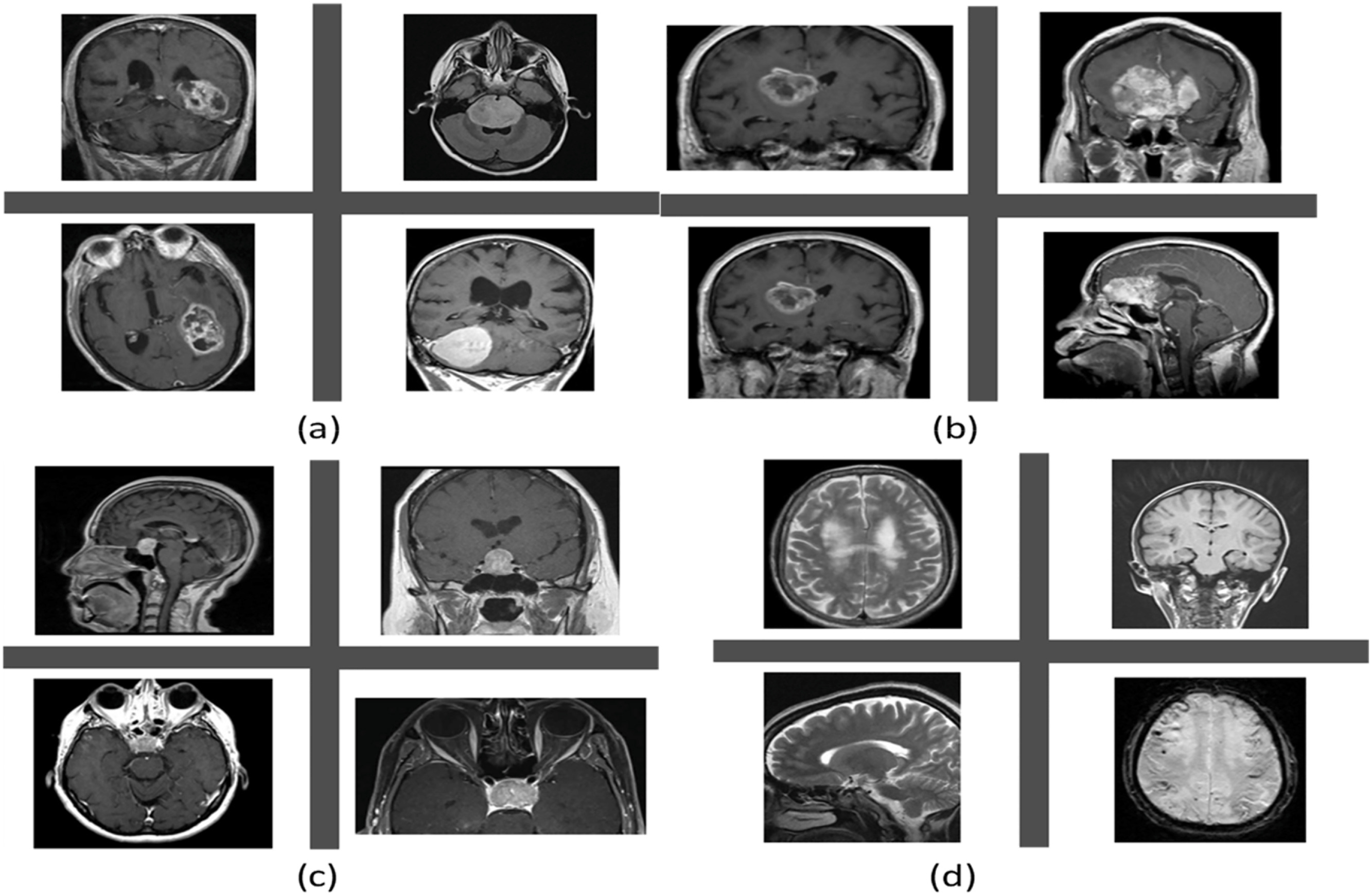 MRI scans of (a) Meningioma; (b) Glioma; (c) Pituitary brain tumor; and (d) non tumor samples. Credit: Healthcare Analytics (2026). DOI: https://doi.org/10.1016/j.health.2026.100456