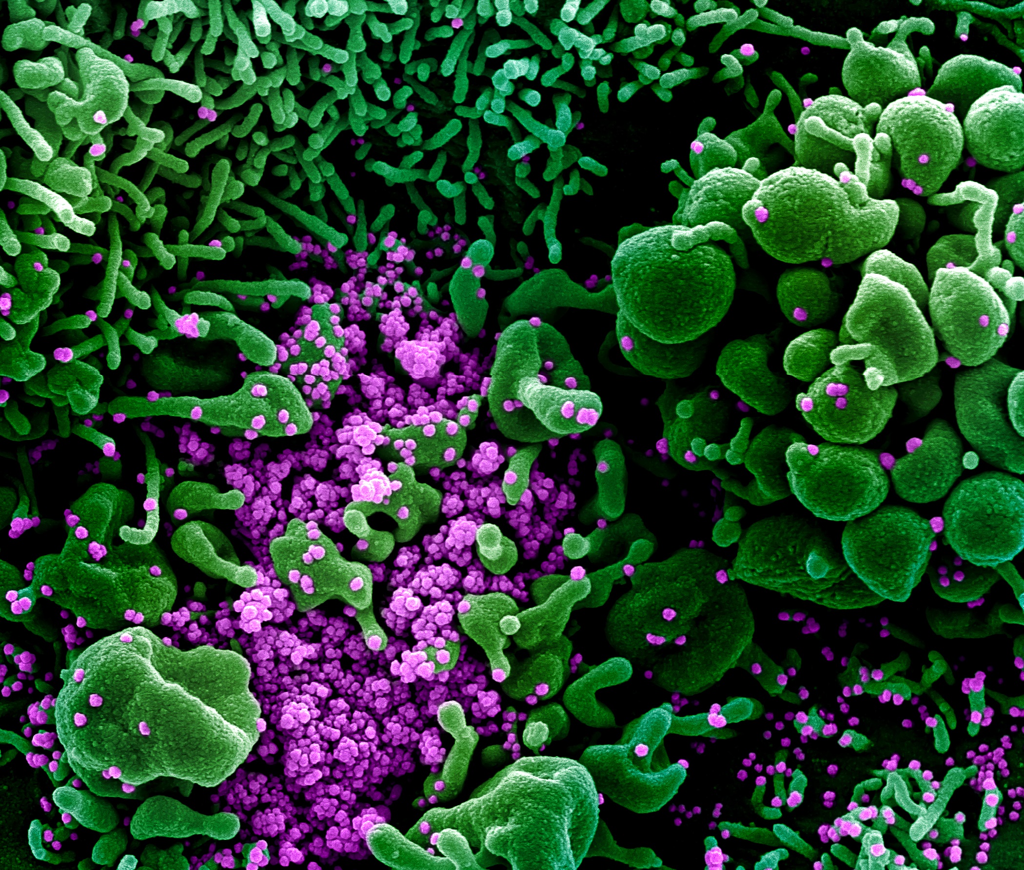 Colourized scanning electron micrograph of an apoptotic cell (green) heavily infected with SARS-COV-2 virus particles (purple), isolated from a patient sample. Image captured and color-enhanced at the NIAID Integrated Research Facility (IRF) in Fort Detrick, Maryland. Credit: NIAID