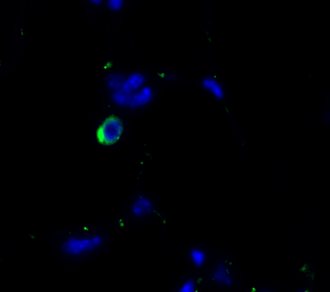 Awakening of dormant cancer cells