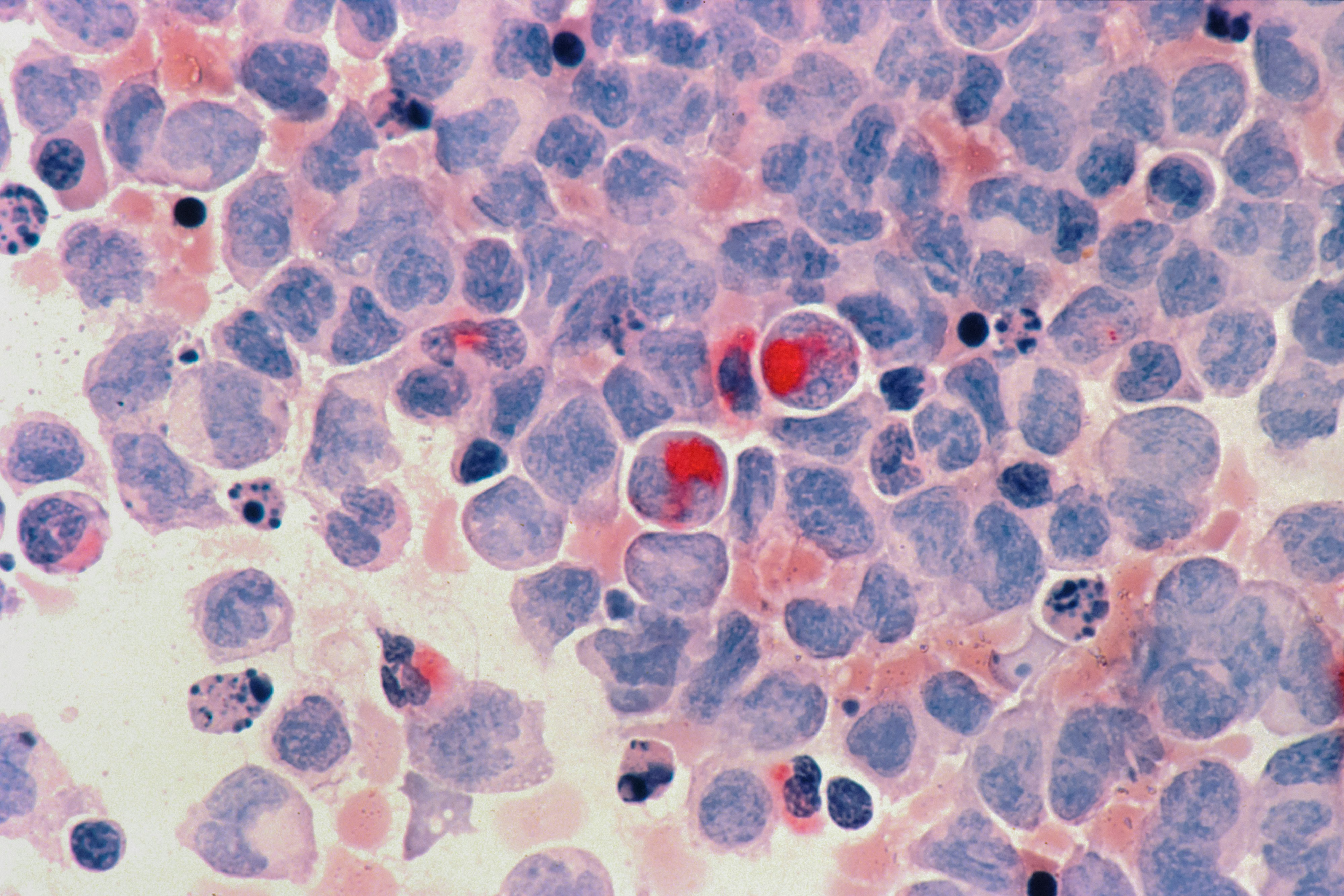 Acute myelocytic leukaemia (AML) CC-0. Story by Dr Joe Milton, Australian Science Media Centre