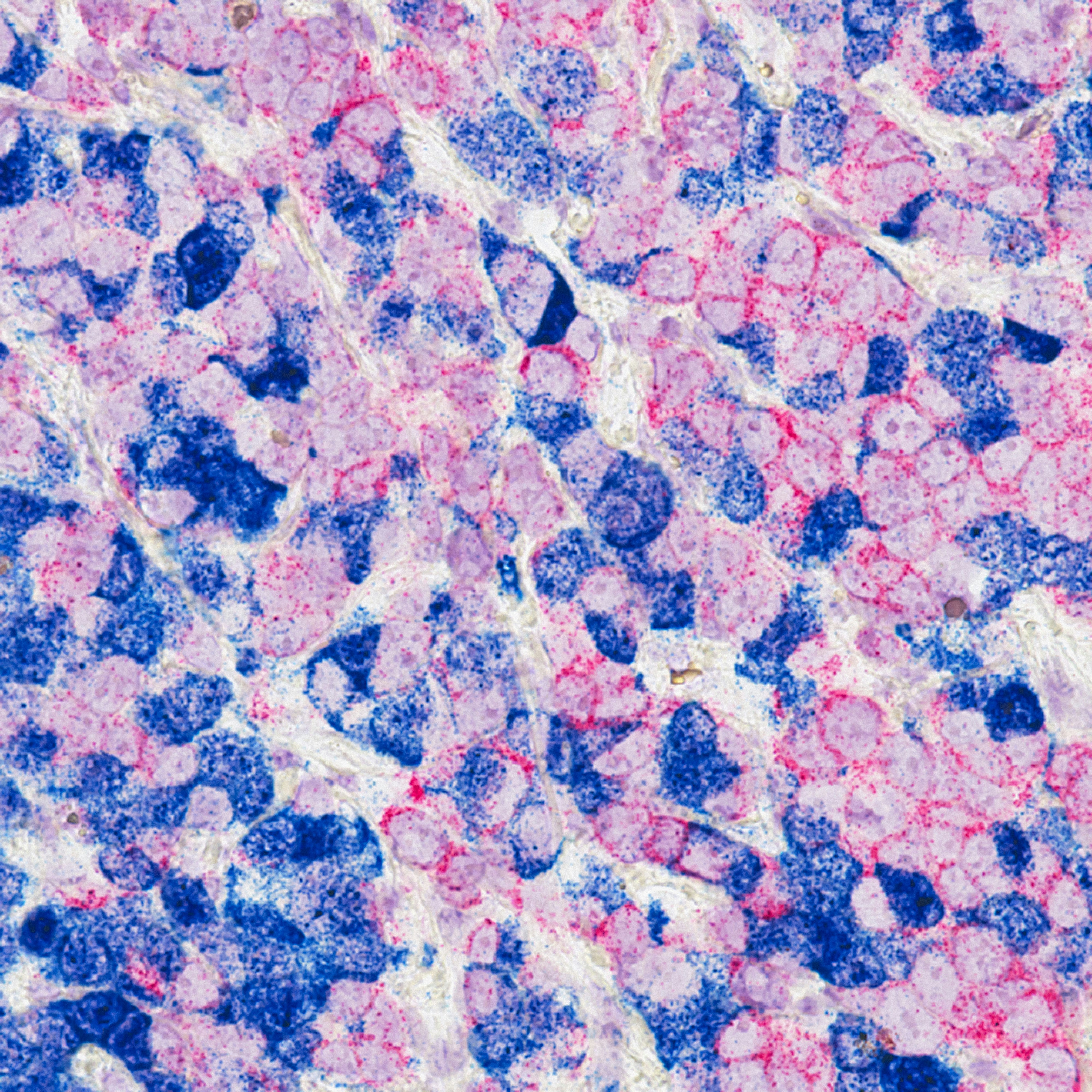 CC-0. Breast cancer cells