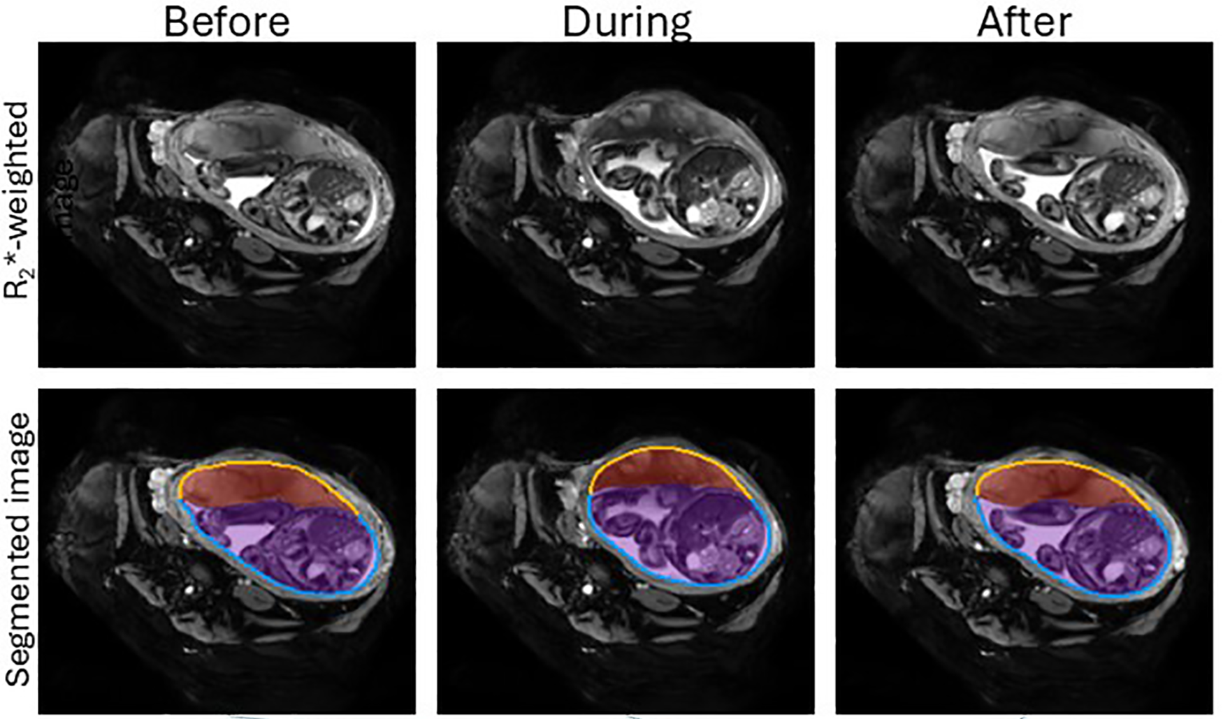 IMAGE: [cropped] Uterine and placental changes during an example placental contraction. The top row shows axial MRI images at selected times points before, during and after a placental contraction. [Plotted changes not shown] CREDIT: Dewick et al., 2026, PLOS One, CC-BY 4.0 (https://creativecommons.org/licenses/by/4.0/)