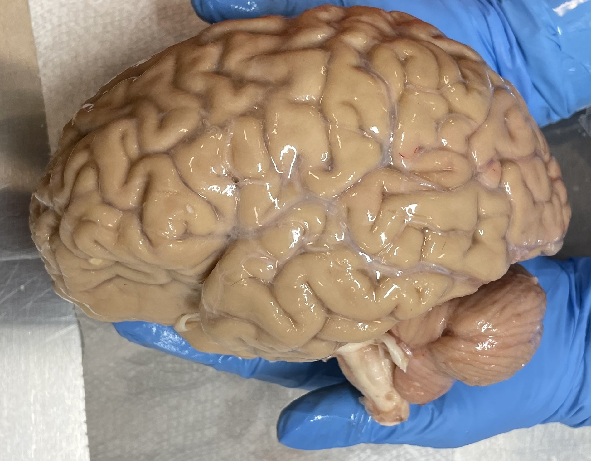 Lateral view of a human brain from the Apex Neuroscience Brain Bank preserved by perfusion fixation.   Image credit: Apex Neuroscience, CC-BY 4.0 (https://creativecommons.org/licenses/by/4.0/) 