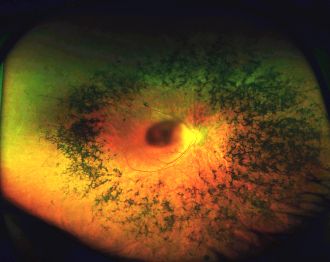 A diseased retina.