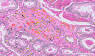 The newly discovered cell type shown clustering around a prostate cancer nerve b