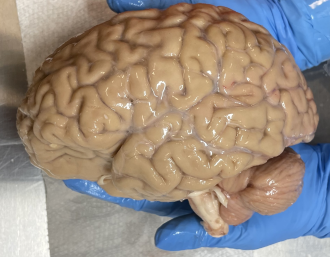 Lateral view of a human brain from the Apex Neuroscience Brain Bank 