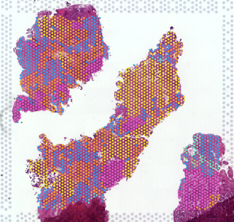 Spatial mapping reveals the complex cellular landscape of prostate tumours.