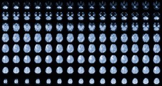 Scientists uncover how glioblastoma cells may survive chemotherapy by hijacking a fertility gene that helps them evade treatment, in a study on animals. Researchers hope the discovery could prevent relapse and lead to safer treatments for brain cancers and other hard-to-treat cancers like ovarian cancer.