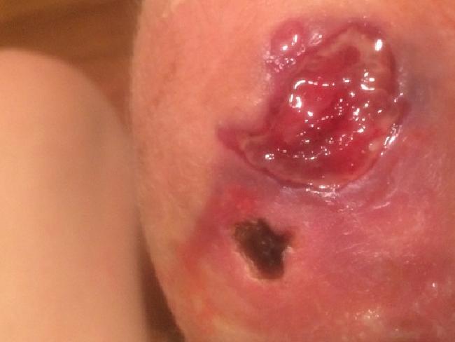 Ella Crofts says a tropical disease found in 33 countries is “running rampant” in Victoria. Picture: Change.org.Source:Supplied