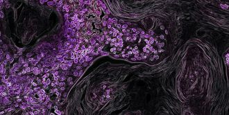 A national, seven‑year program has launched to transform Australia’s prevention, diagnosis and treatment of metabolic (dysfunction) associated fatty liver disease (MAFLD), a rapidly growing condition affecting up to one in three adults and the leading cause of chronic liver disease, with no approved drugs currently. Headquartered at the Storr Liver Centre, Westmead Institute for Medical Research, the initiative unites leading researchers and clinicians nationwide, including the Centenary Institute, the University of Sydney’s Charles Perkins Centre, Westmead and Royal Prince Alfred hospitals.