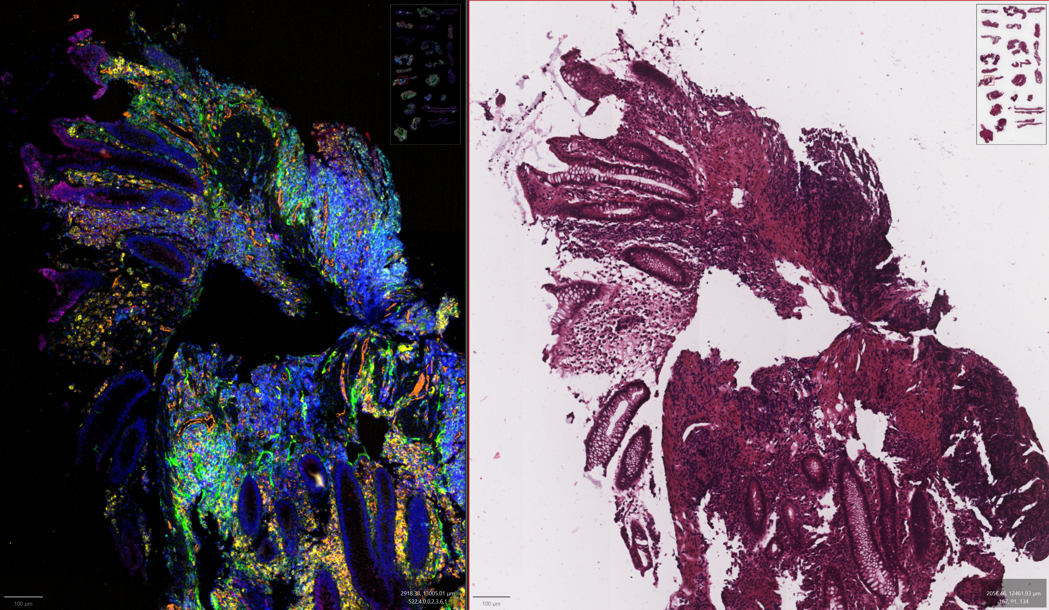 Tissue sample spatial analysis (on left) and standard H&E image (on right) - supplied QIMR Berghofer