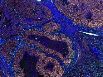 Melanoma microscopy