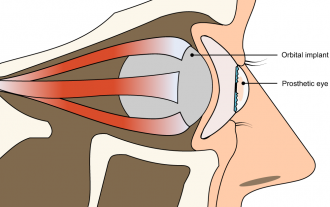 Simplified schematic of an ocular prosthetic