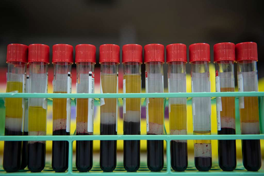 CC-0. https://picryl.com/media/blood-samples-wait-to-be-examined-after-going-through-85ec8d