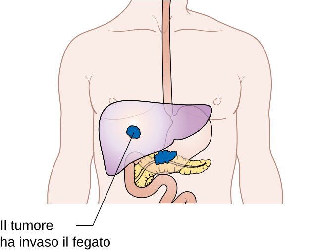  Diagram showing pancreatic cancer that has spread. Credit: https://commons.wikimedia.org/wiki/File:Diagram_showing_pancreatic_cancer_that_has_spread_(M_staging)_CRUK_179-it.svg