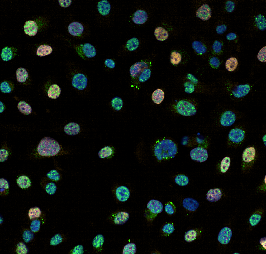 The ‘splicing’ mechanism in cancer cells allows them to repair their DNA and avoid the cell death caused by PARP inhibitor therapy, resulting in drug resistance. Under a microscope, DNA repair is visible as bright green spots ("foci") in the blue-stained cell DNA. Orange highlights actively growing cancer cells. Credit: WEHI 