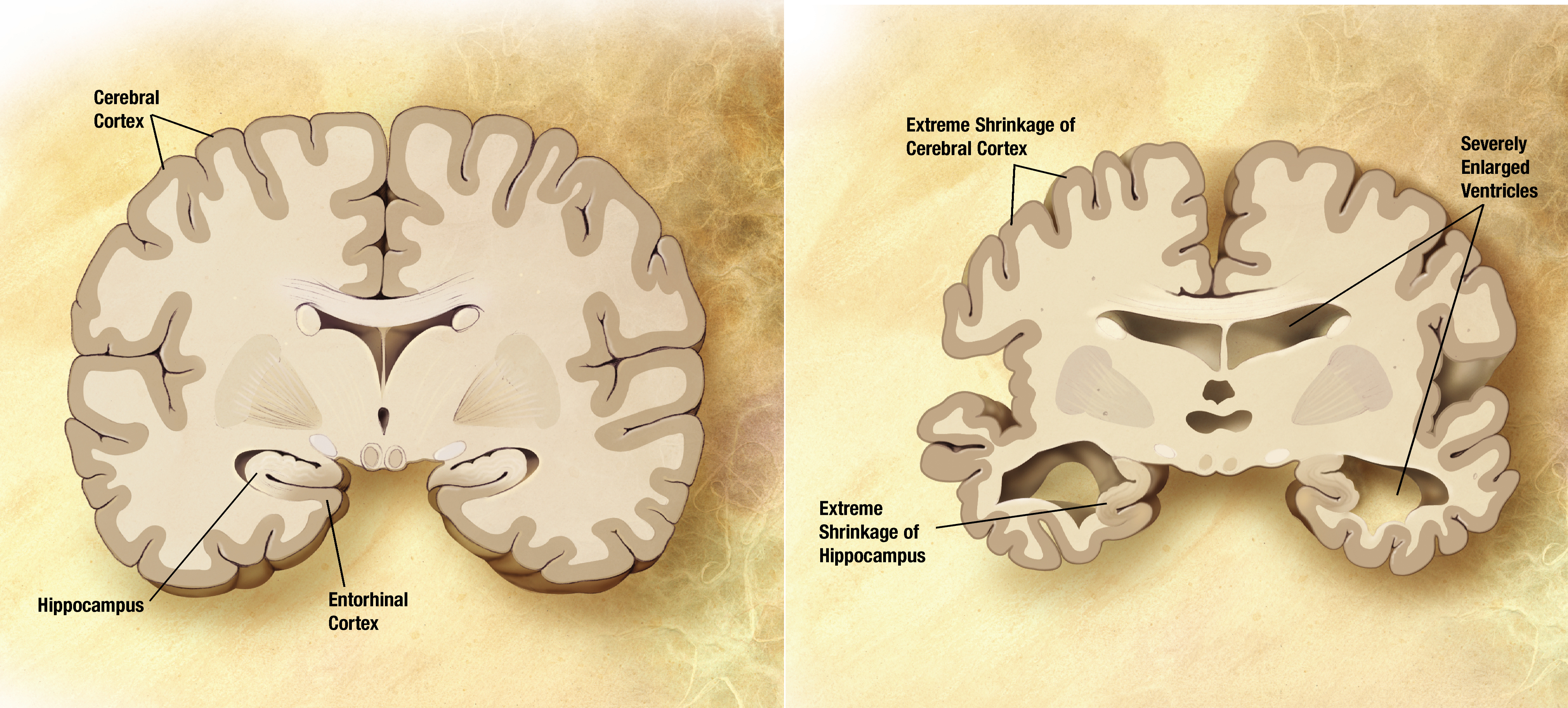 Normal brain compared with Alzheimer's brain