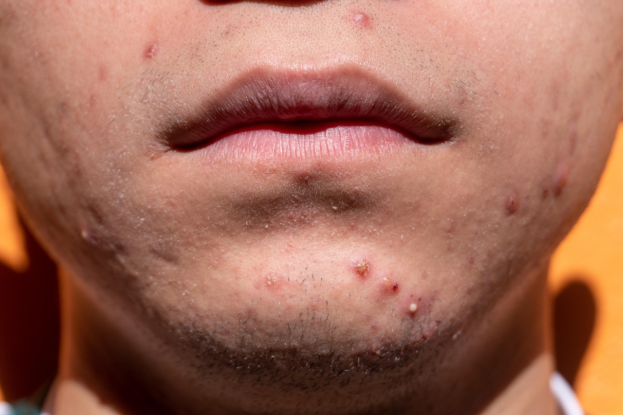 CC-0. https://pixabay.com/photos/acne-shin-dermatology-skin-puberty-6822174/