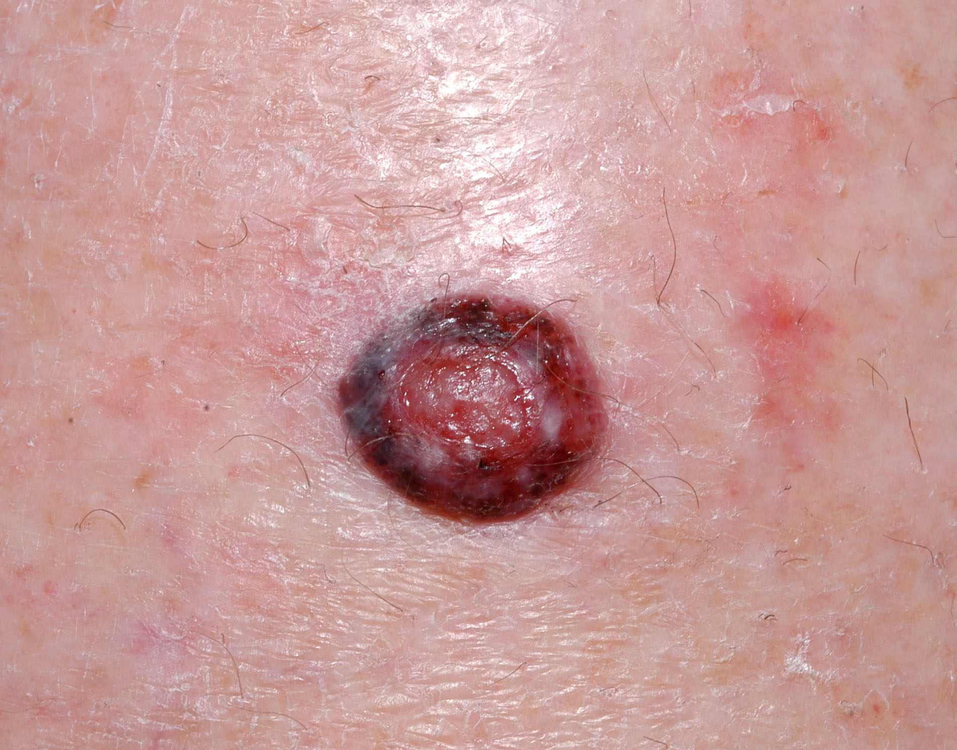 Nodular melanoma.  Attribution: Melanoma Institute Australia 