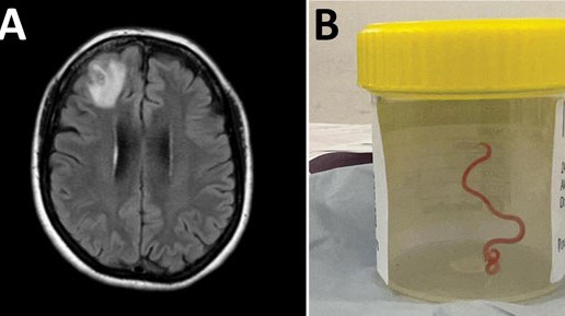 Detection of Ophidascaris robertsi nematode infection in a 64-year-old woman from southeastern New South Wales, Australia. A) Magnetic resonance image of patient’s brain by fluid-attenuated inversion recovery demonstrating an enhancing right frontal lobe lesion, 13 × 10 mm. B) Live third-stage larval form of Ophidascaris robertsi (80 mm long, 1 mm diameter) removed from the patient’s right frontal lobe. Credit: Hossain M, Kennedy KJ, Wilson HL, et al. Human Neural Larva Migrans Caused by Ophidascaris robertsi Ascarid. Emerging Infectious Diseases. 2023;29(9):1900-1903. doi:10.3201/eid2909.230351.