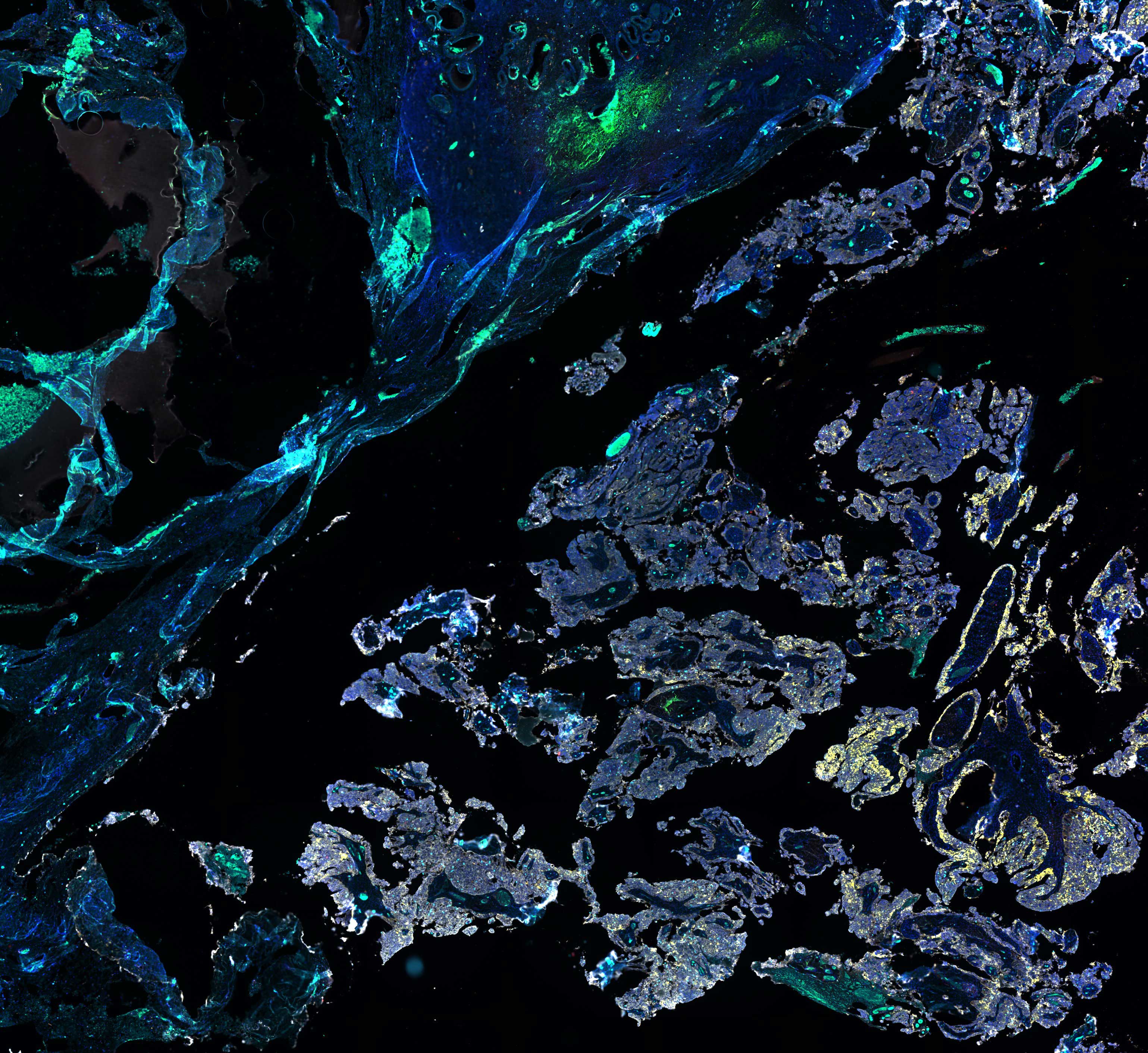 Pictured: A section of an ovarian tumour with cancer cells (in white) and immune cells (in cyan). The EPOCH trial will assess whether a chemotherapy drug used to treat aggressive breast cancers, can boost the body’s immune response and, together with an immunotherapy drug, can halt tumour progression in patients with ovarian and uterine carcinosarcoma.  Credit: Kristy Shield-Artin and Suzan Sam, WEHI 