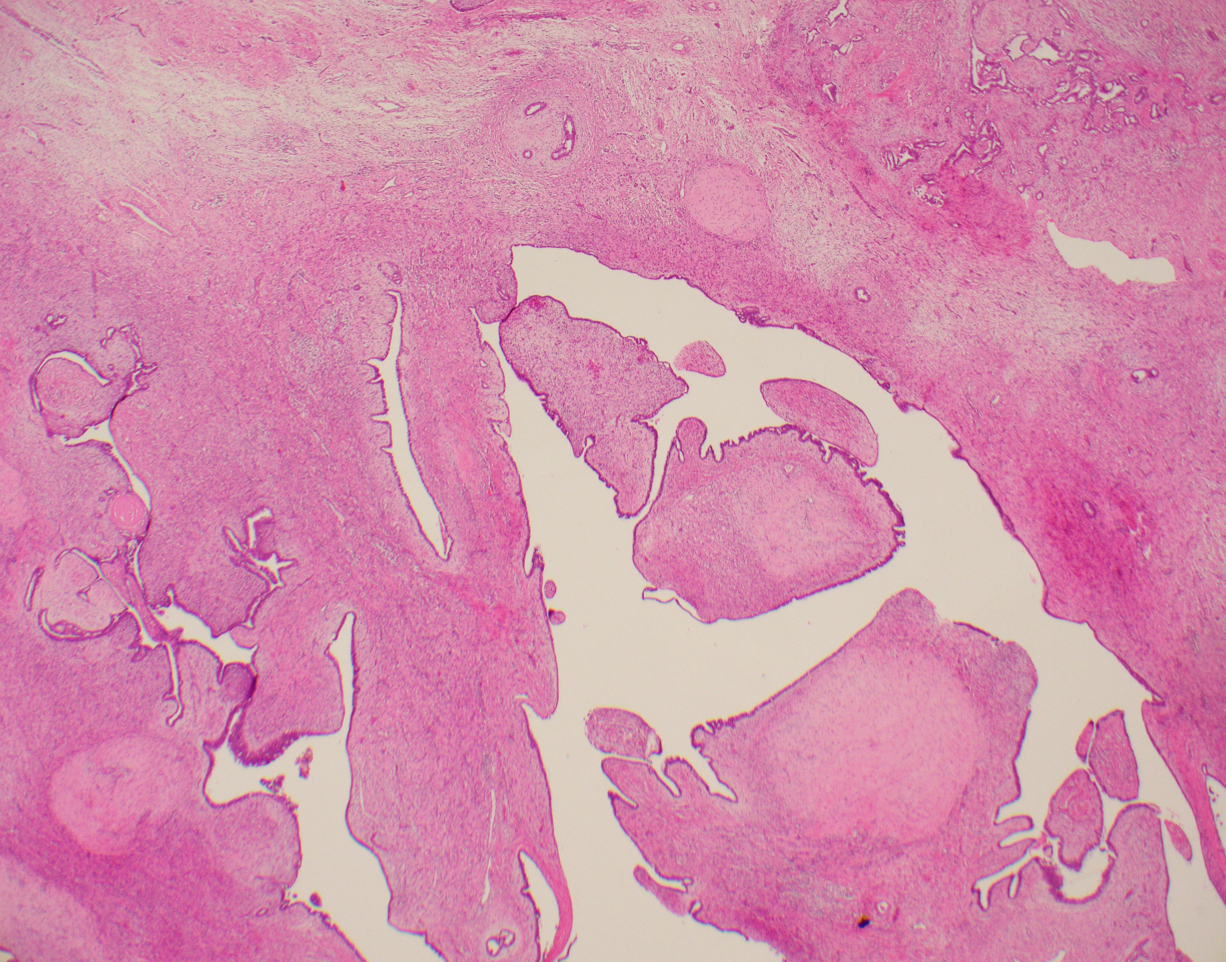 A phyllodes tumour's characteristic leaf-like cellular structure is not enough to identify it as malignant or benign, as in this borderline case.