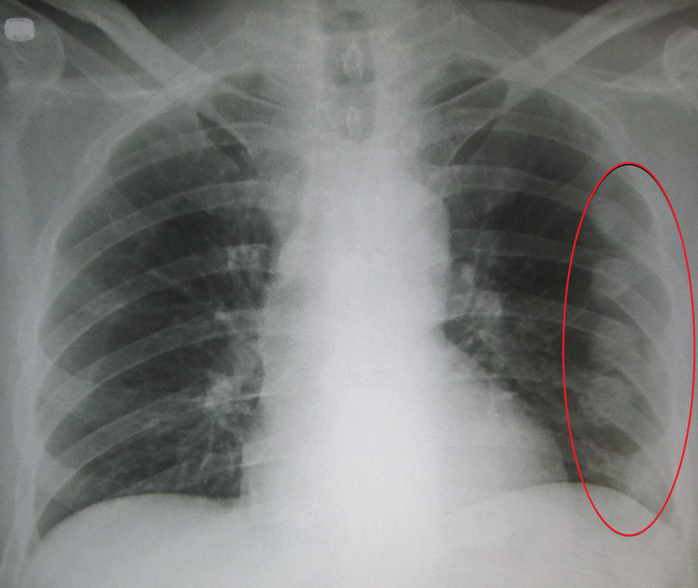 An X ray showing multiple old fractured ribs of the persons left side as marked by the oval, James Heilman, Wikimedia Commons - https://commons.wikimedia.org/wiki/File:Fracturedribsmarked.jpg